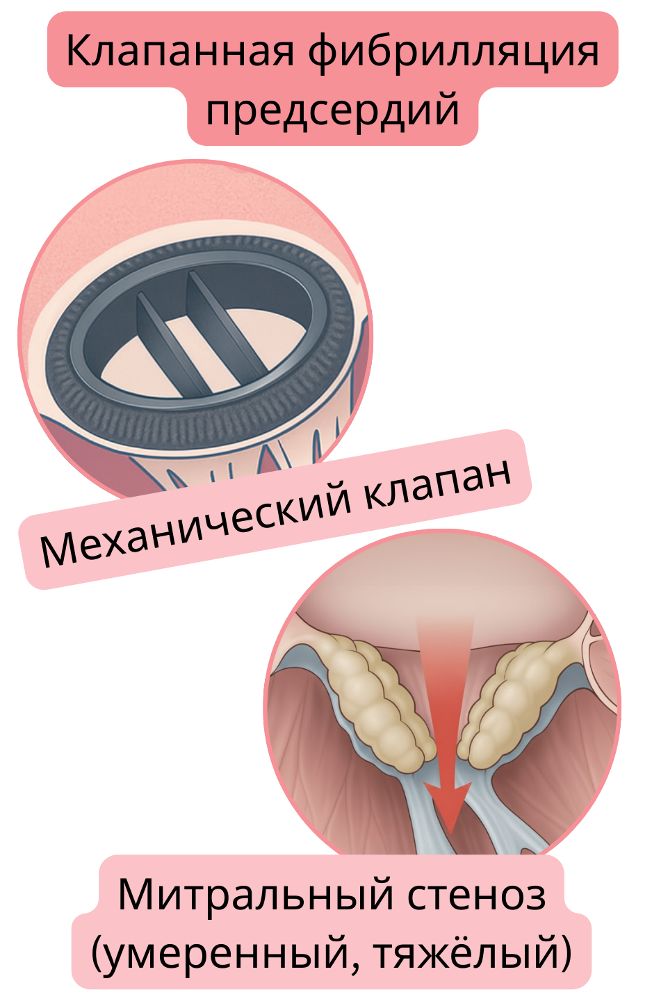 Иллюстрация клапанной фибрилляции предсердий при наличии механического клапана и митрального стеноза средней или тяжёлой степени.