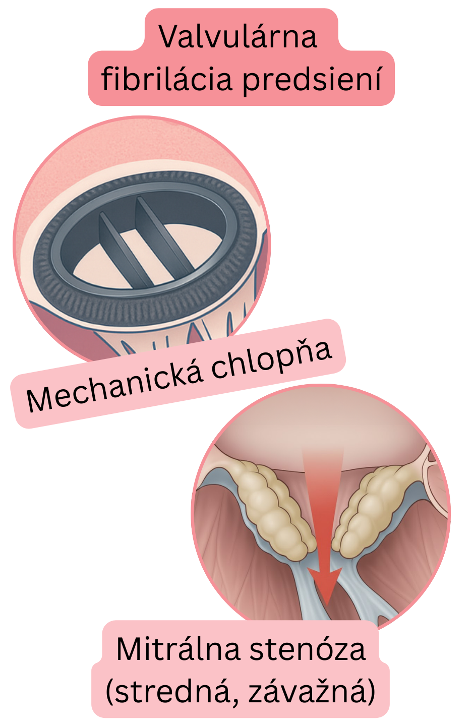Ilustrácia valvulárnej fibrilácie predsiení pri mechanickej chlopni a strednej až závažnej mitrálnej stenóze.