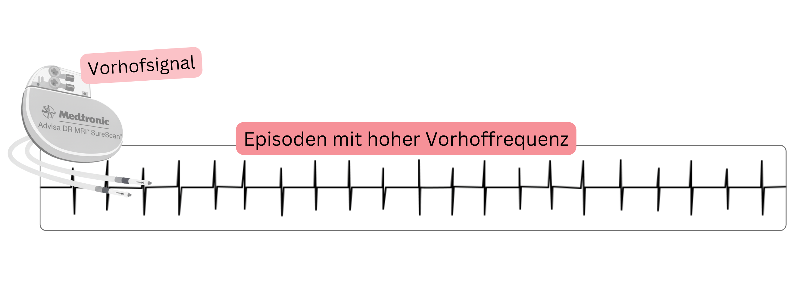 Aufzeichnung eines atrialen Hochfrequenzereignisses (AHRE), detektiert durch ein implantiertes kardiales Gerät, als Ausdruck eines subklinischen Vorhofflimmerns.