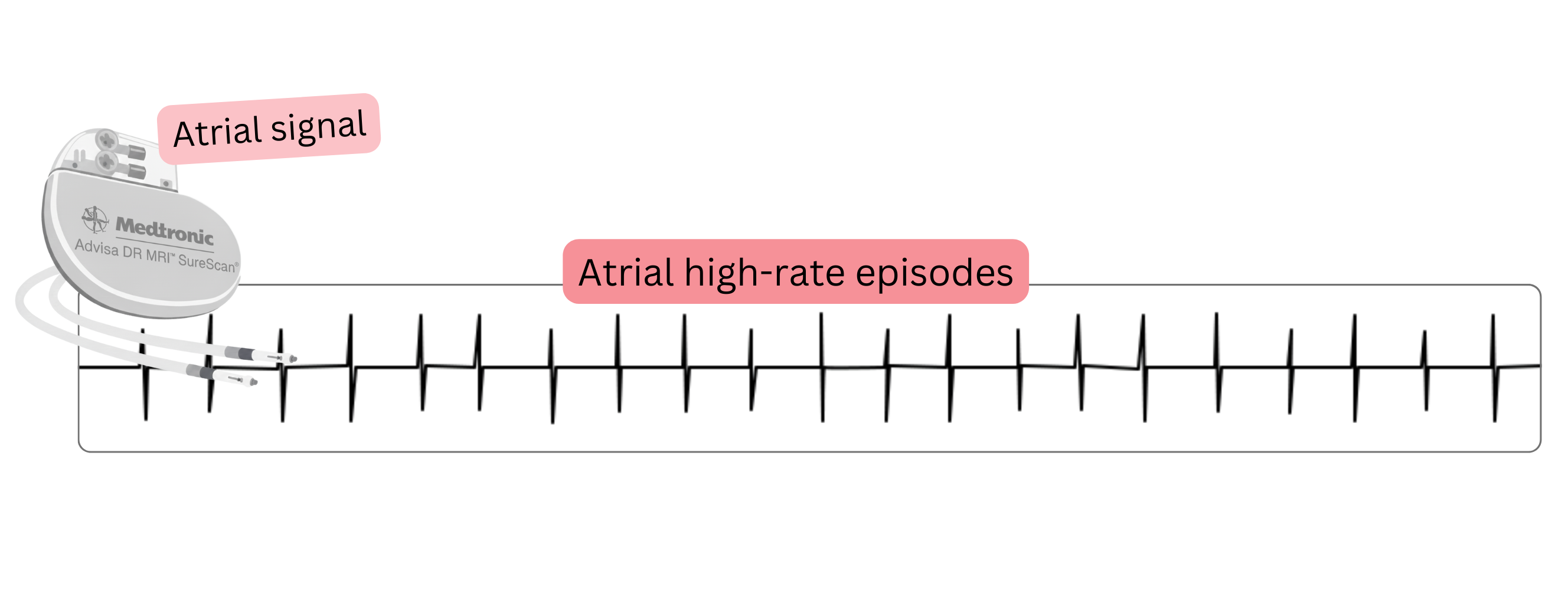 Recording of an atrial high-rate episode (AHRE) detected by an implanted cardiac device as a manifestation of subclinical atrial fibrillation.