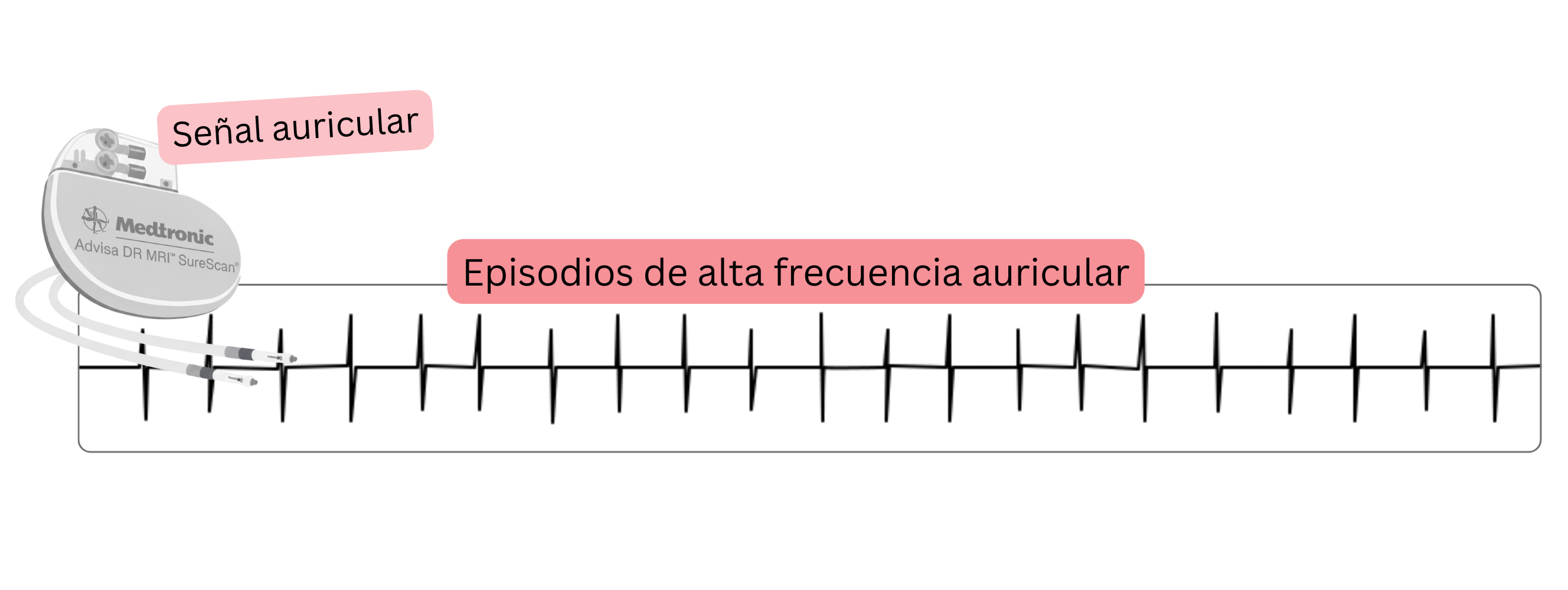 Registro de un episodio auricular de alta frecuencia (AHRE) detectado por un dispositivo cardíaco implantable como manifestación de fibrilación auricular subclínica.