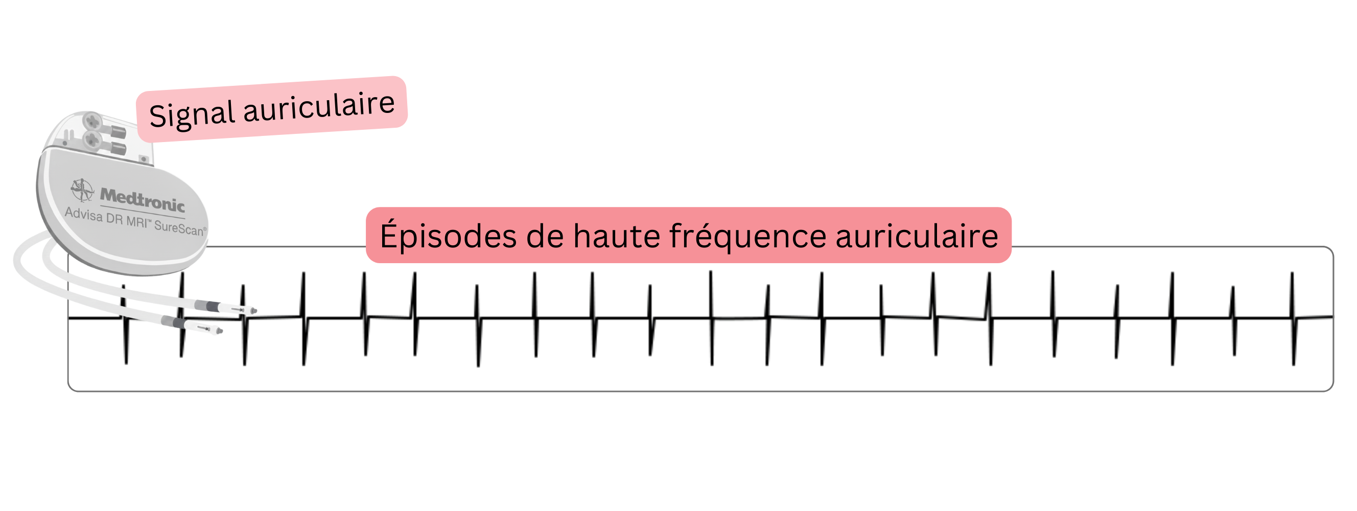 Enregistrement d’un épisode auriculaire à haute fréquence (AHRE) détecté par un dispositif cardiaque implantable, en tant que manifestation de fibrillation atriale subclinique.