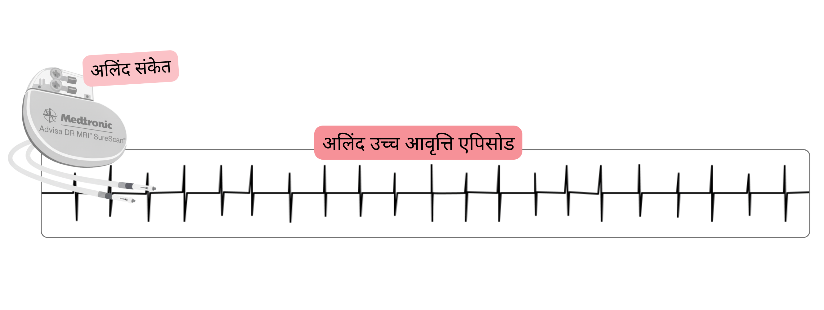 इम्प्लांट किए गए कार्डियक डिवाइस द्वारा पता लगाए गए एट्रियल हाई-रेट एपिसोड (AHRE) की रिकॉर्डिंग, जो सबक्लिनिकल एट्रियल फिब्रिलेशन का संकेत है।