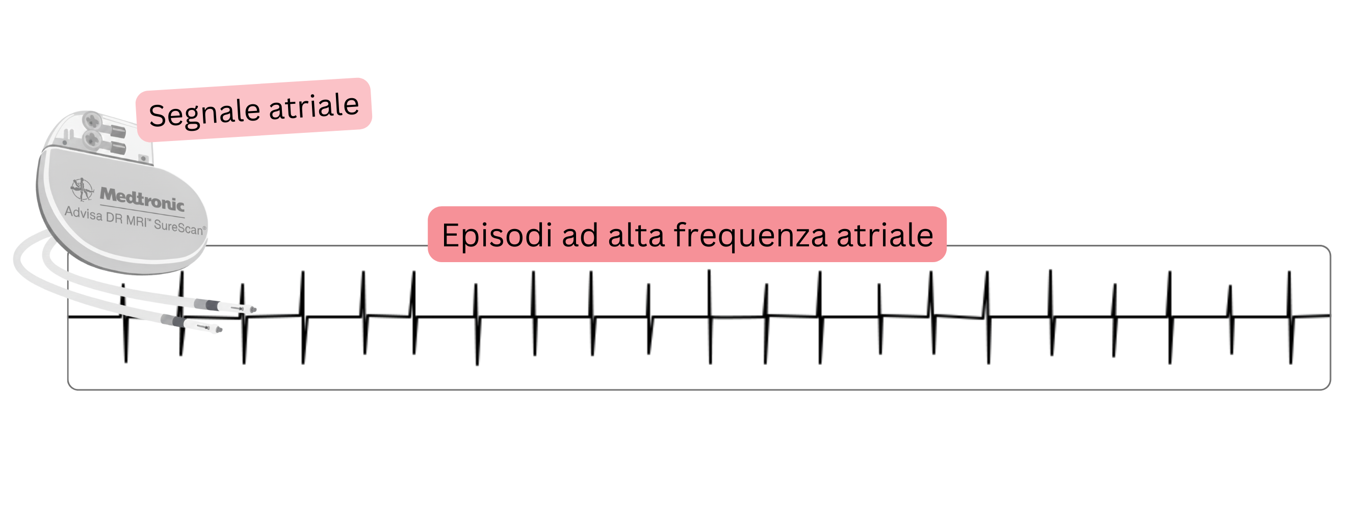 Registrazione di un episodio atriale ad alta frequenza (AHRE) rilevato da un dispositivo cardiaco impiantabile come manifestazione di fibrillazione atriale subclinica.