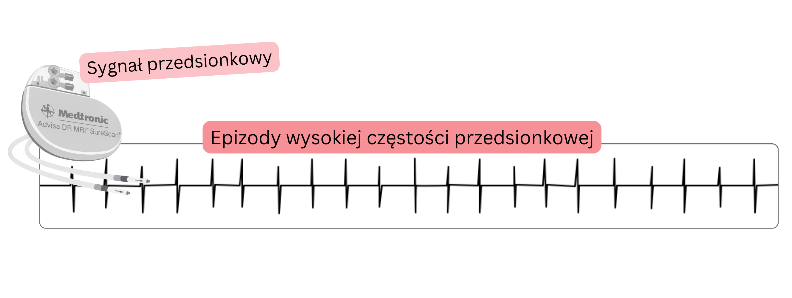Zapis przedsionkowego epizodu wysokiej częstości (AHRE) wykrytego przez wszczepione urządzenie kardiologiczne jako przejaw subklinicznego migotania przedsionków.