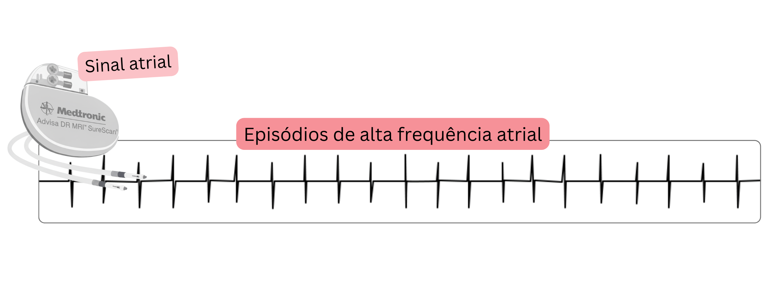 Registo de um episódio auricular de alta frequência (AHRE) detetado por um dispositivo cardíaco implantável como manifestação de fibrilação atrial subclínica.