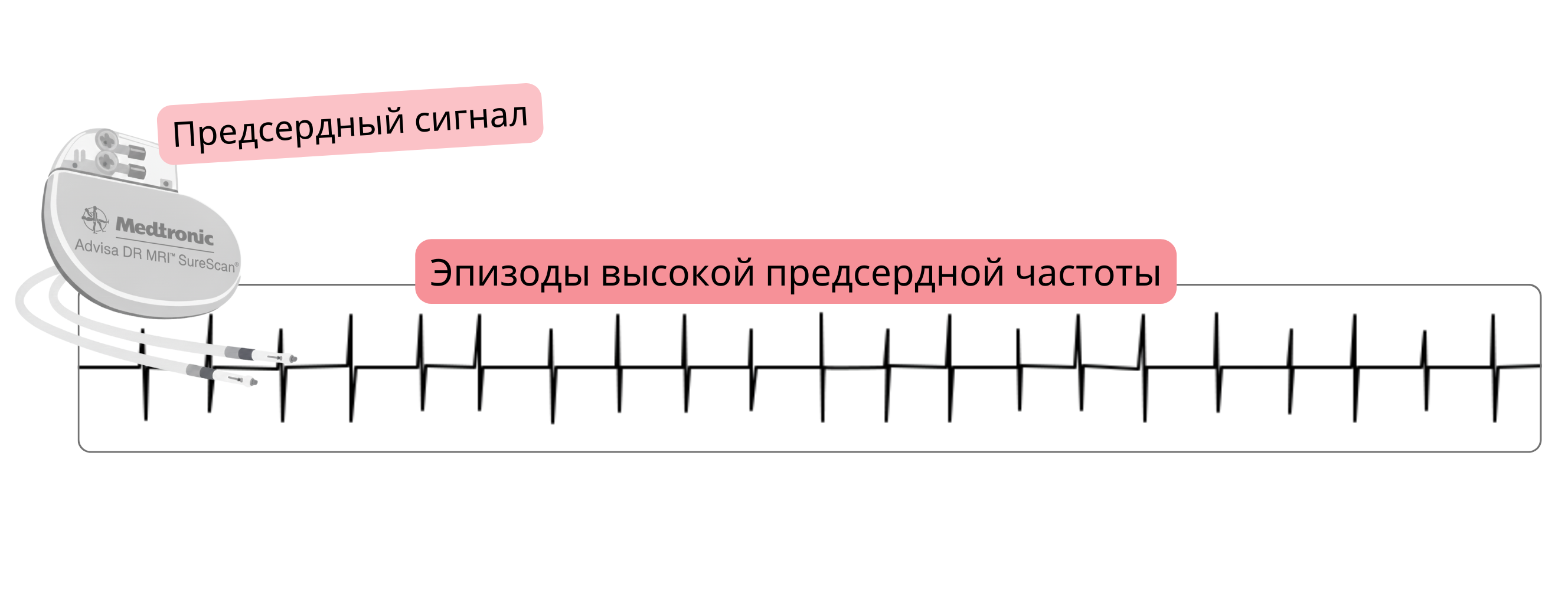 Запись предсердного эпизода высокой частоты (AHRE), выявленного имплантированным кардиальным устройством, как проявления субклинической фибрилляции предсердий.