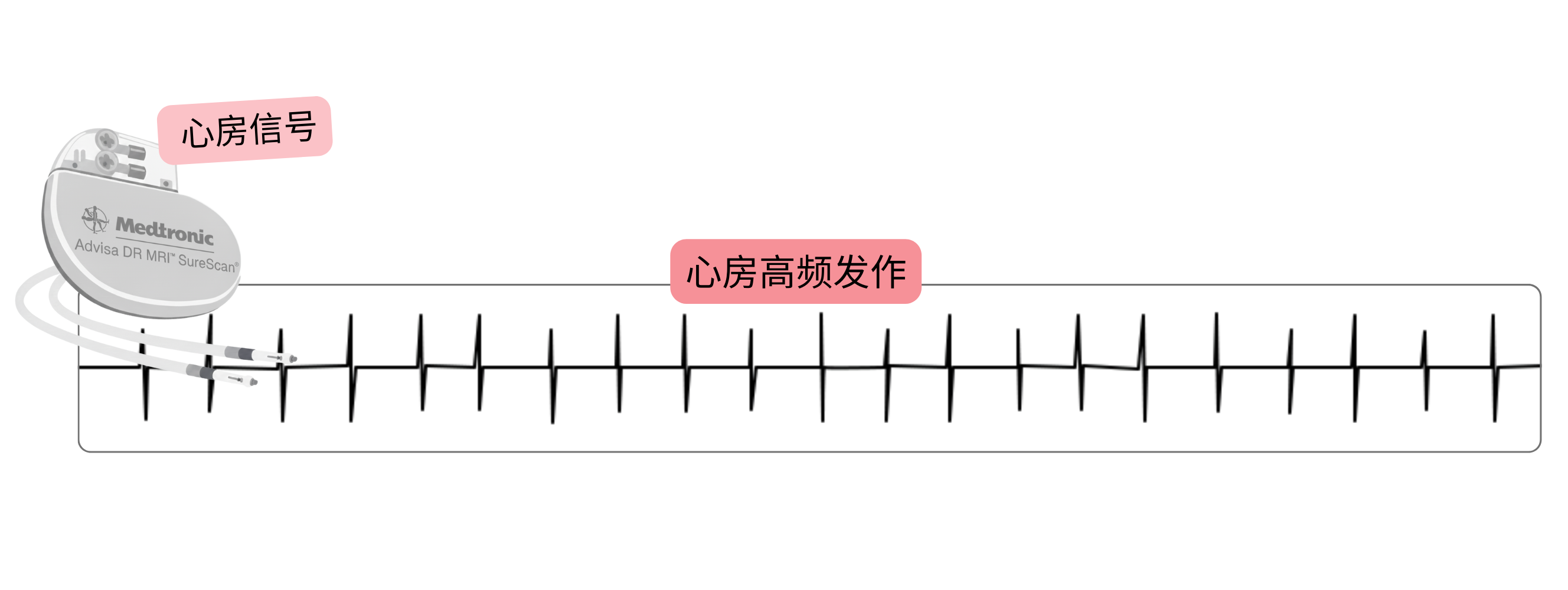 植入式心脏装置检测到的心房高频发作（AHRE）记录，作为亚临床心房颤动的表现。