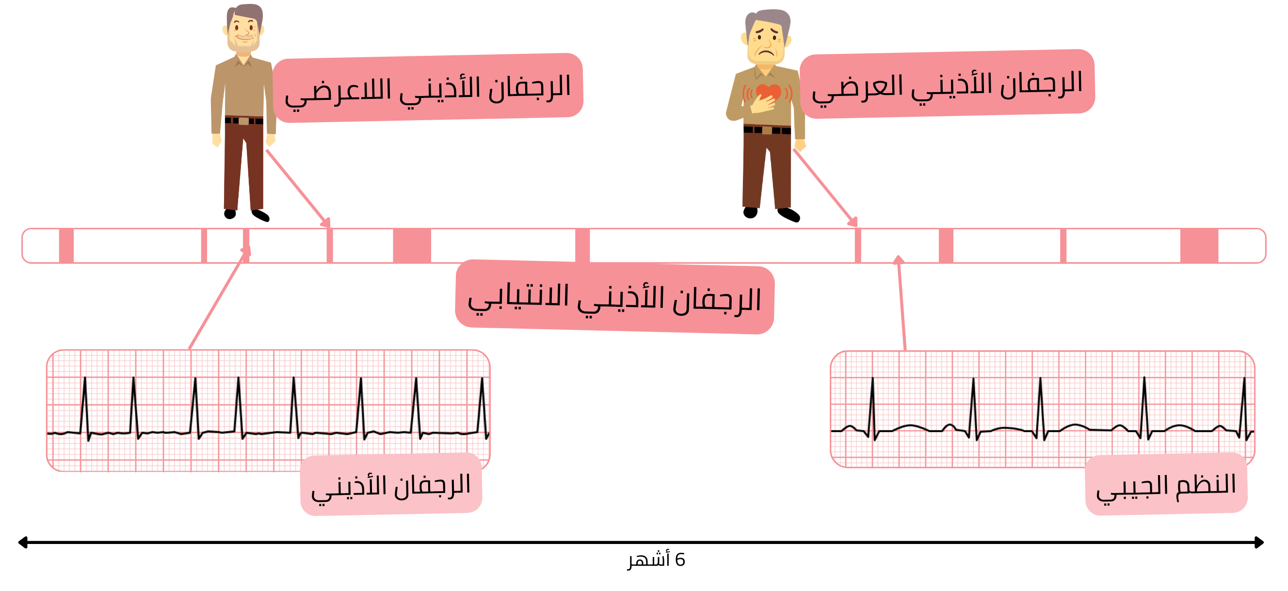 مخطط للرجفان الأذيني الانتيابي يوضح تناوب نوبات الرجفان الأذيني مع النظم الجيبي لدى المرضى العرضيين وعديمي الأعراض.