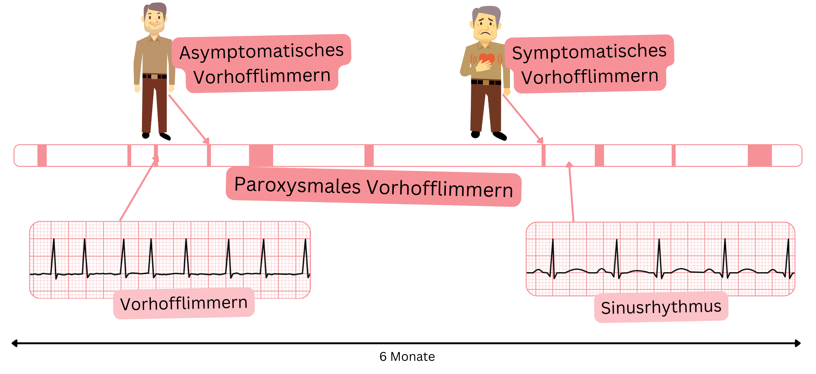 Schema des paroxysmalen Vorhofflimmerns mit Darstellung des Wechsels zwischen Episoden von Vorhofflimmern und Sinusrhythmus bei symptomatischen und asymptomatischen Patienten.