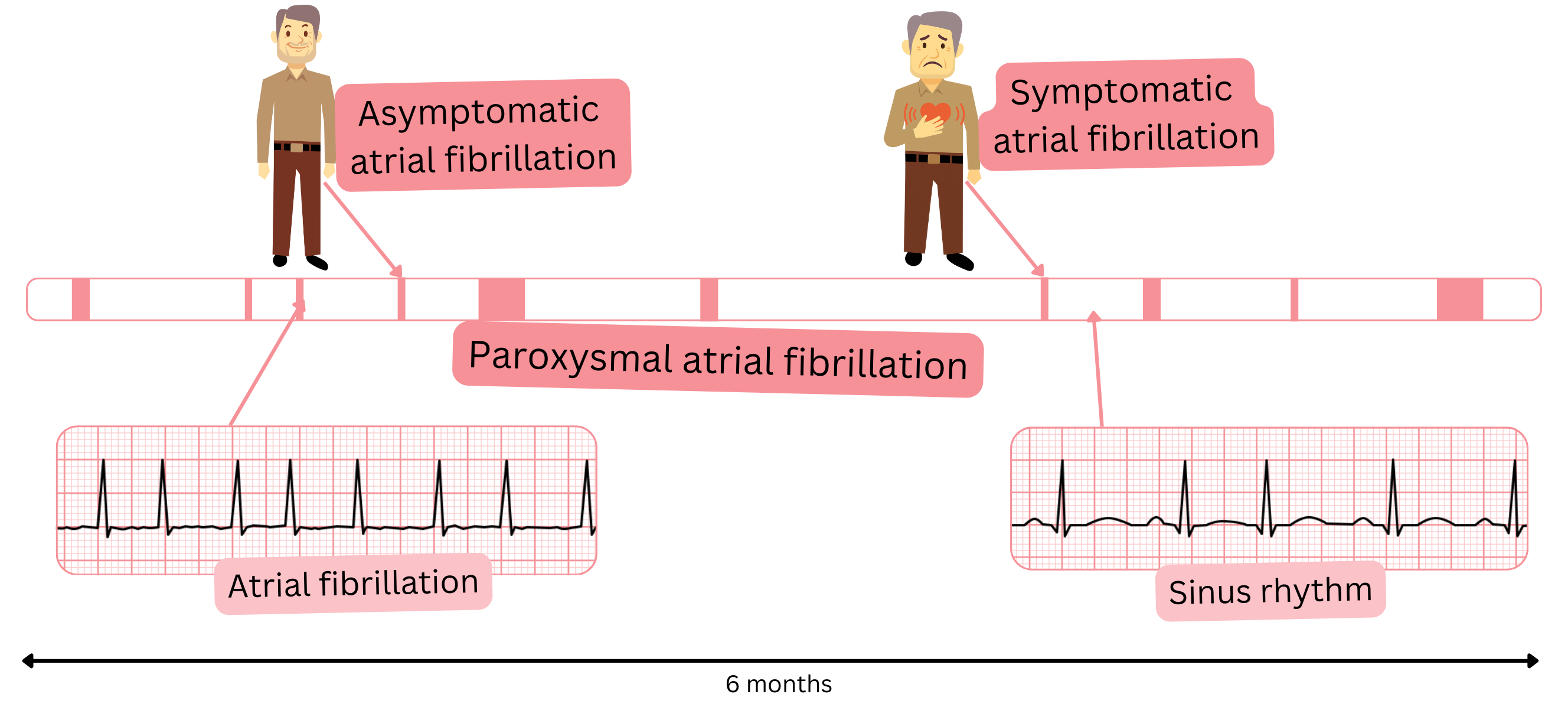 Diagram of paroxysmal atrial fibrillation illustrating alternating episodes of atrial fibrillation and sinus rhythm in symptomatic and asymptomatic patients.