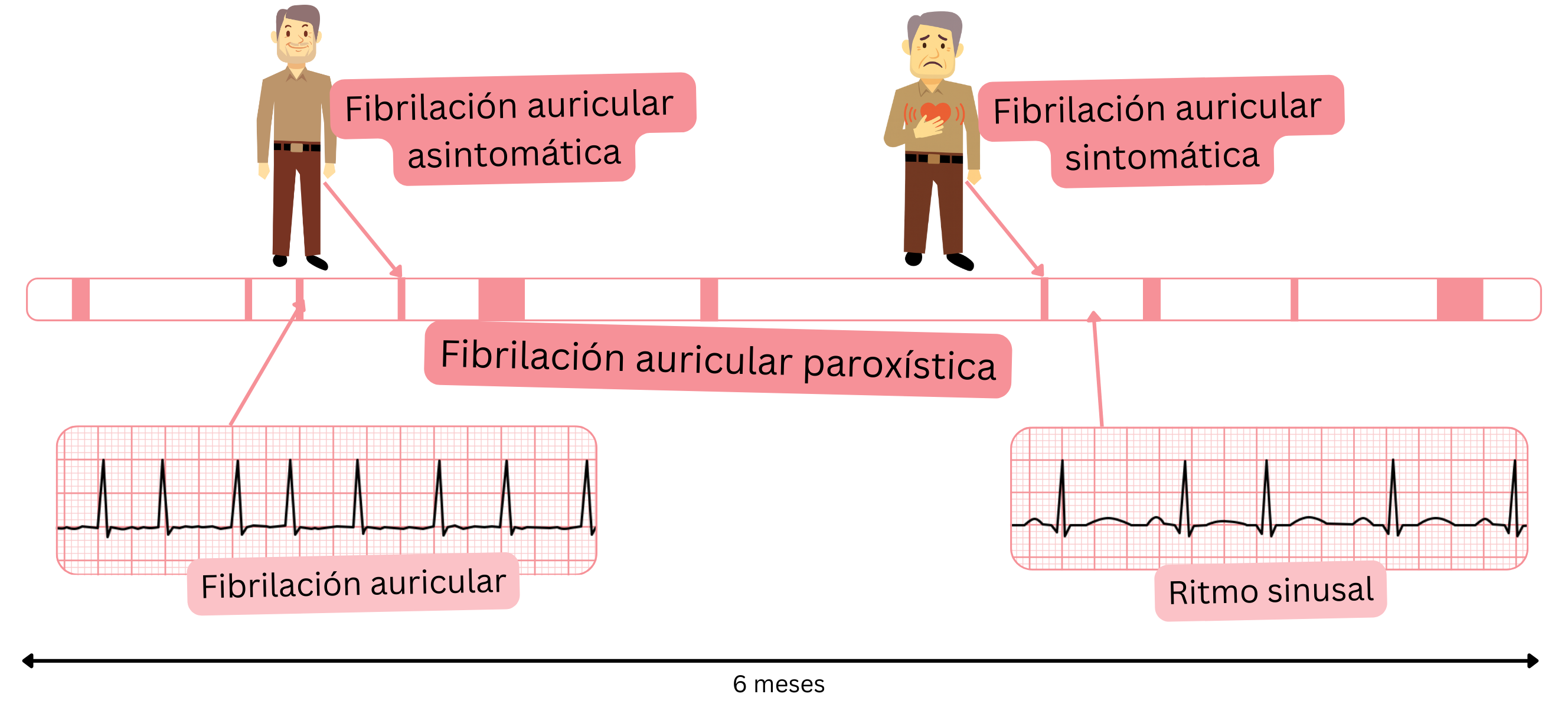 Esquema de la fibrilación auricular paroxística que muestra la alternancia de episodios de fibrilación auricular y ritmo sinusal en pacientes sintomáticos y asintomáticos.