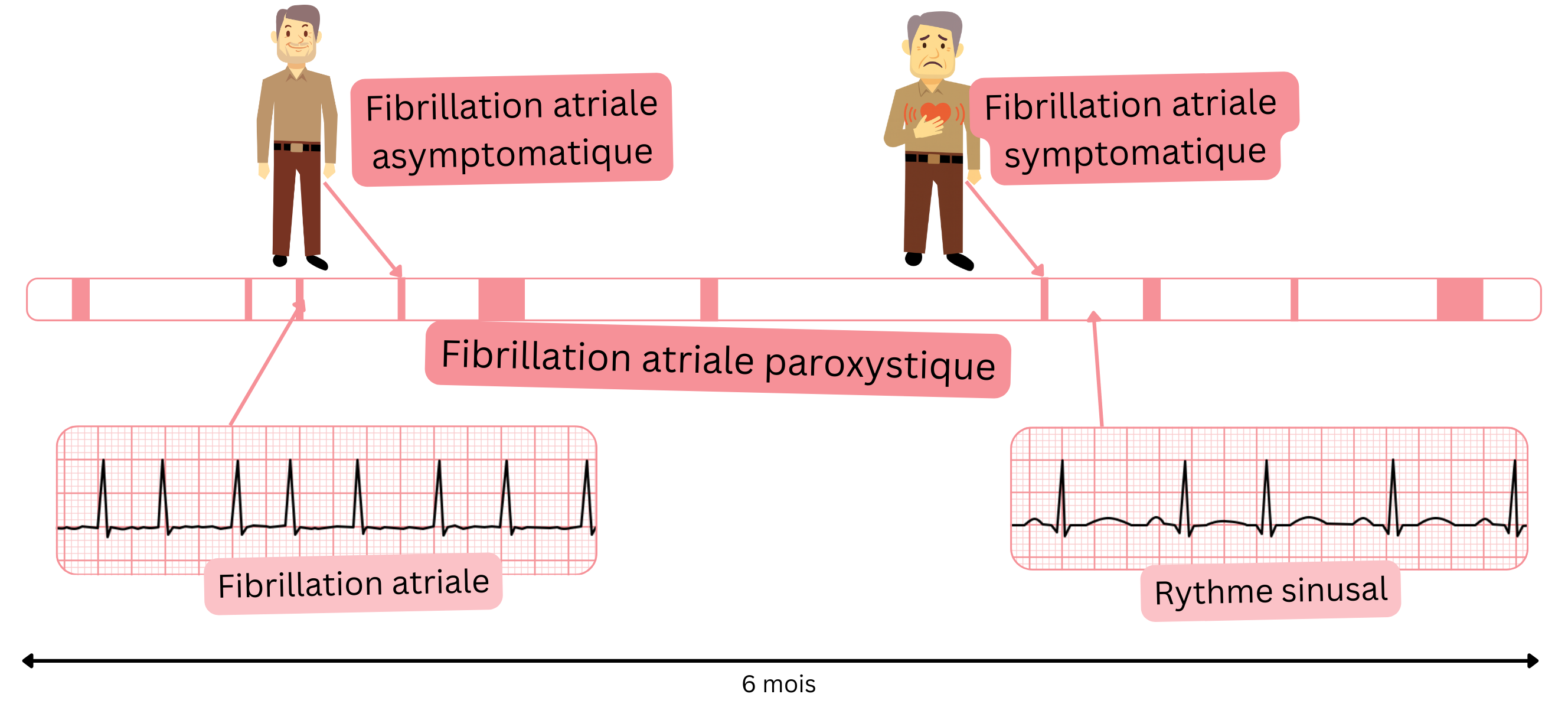 Schéma de la fibrillation atriale paroxystique illustrant l’alternance d’épisodes de fibrillation atriale et de rythme sinusal chez des patients symptomatiques et asymptomatiques.