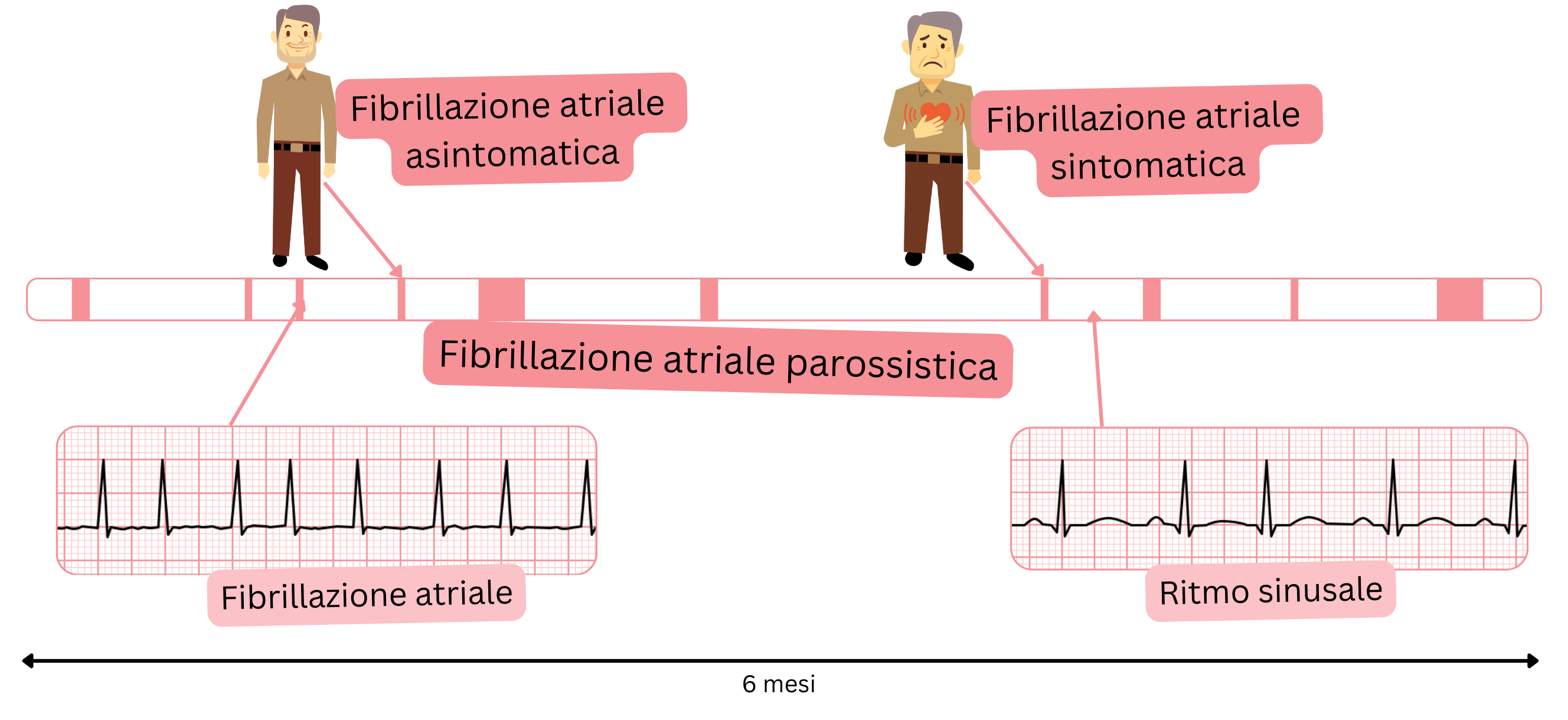 Schema della fibrillazione atriale parossistica che illustra l’alternanza di episodi di fibrillazione atriale e ritmo sinusale in pazienti sintomatici e asintomatici.
