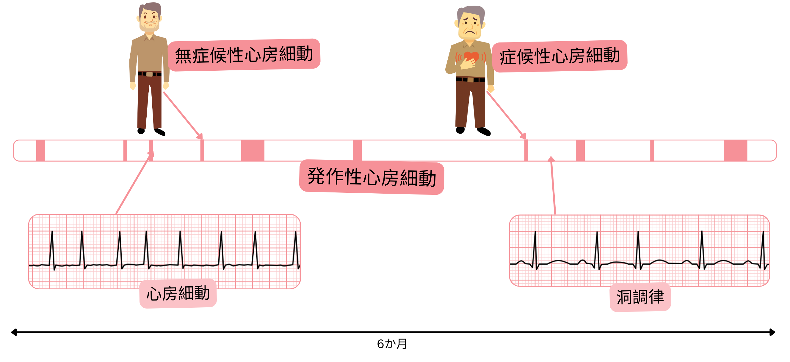 症候性および無症候性患者において、心房細動エピソードと洞調律が交互に出現する発作性心房細動を示す模式図。