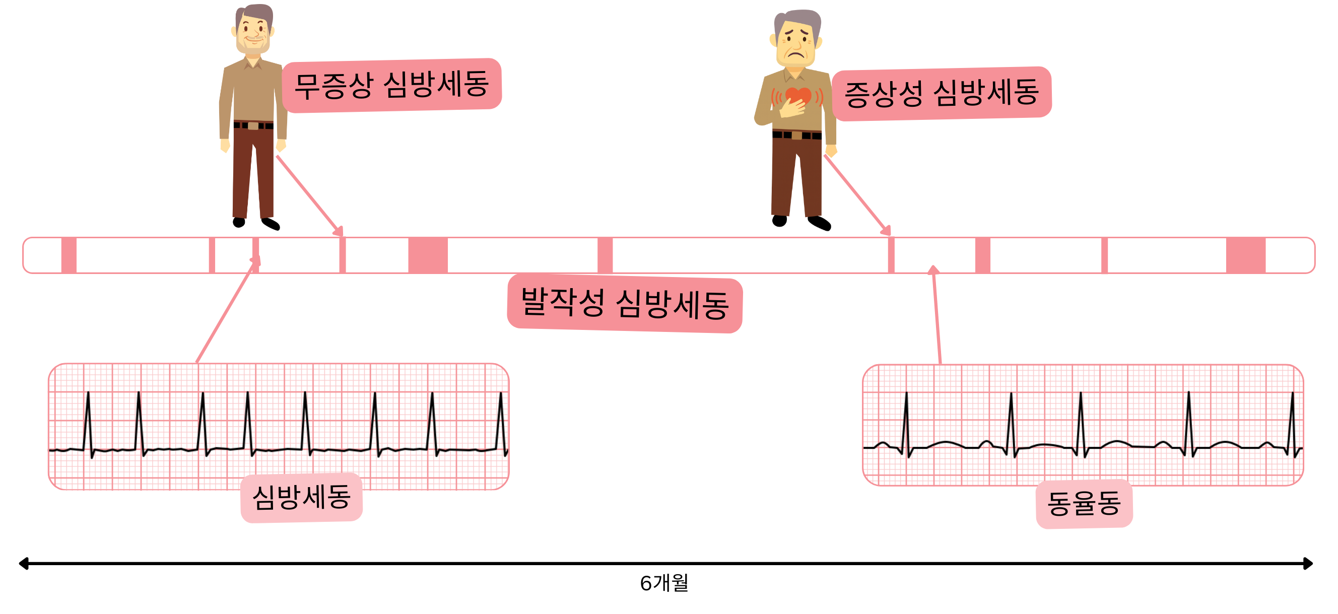 증상이 있는 환자와 무증상 환자에서 심방세동 발작과 동율동이 번갈아 나타나는 발작성 심방세동을 보여주는 도식.