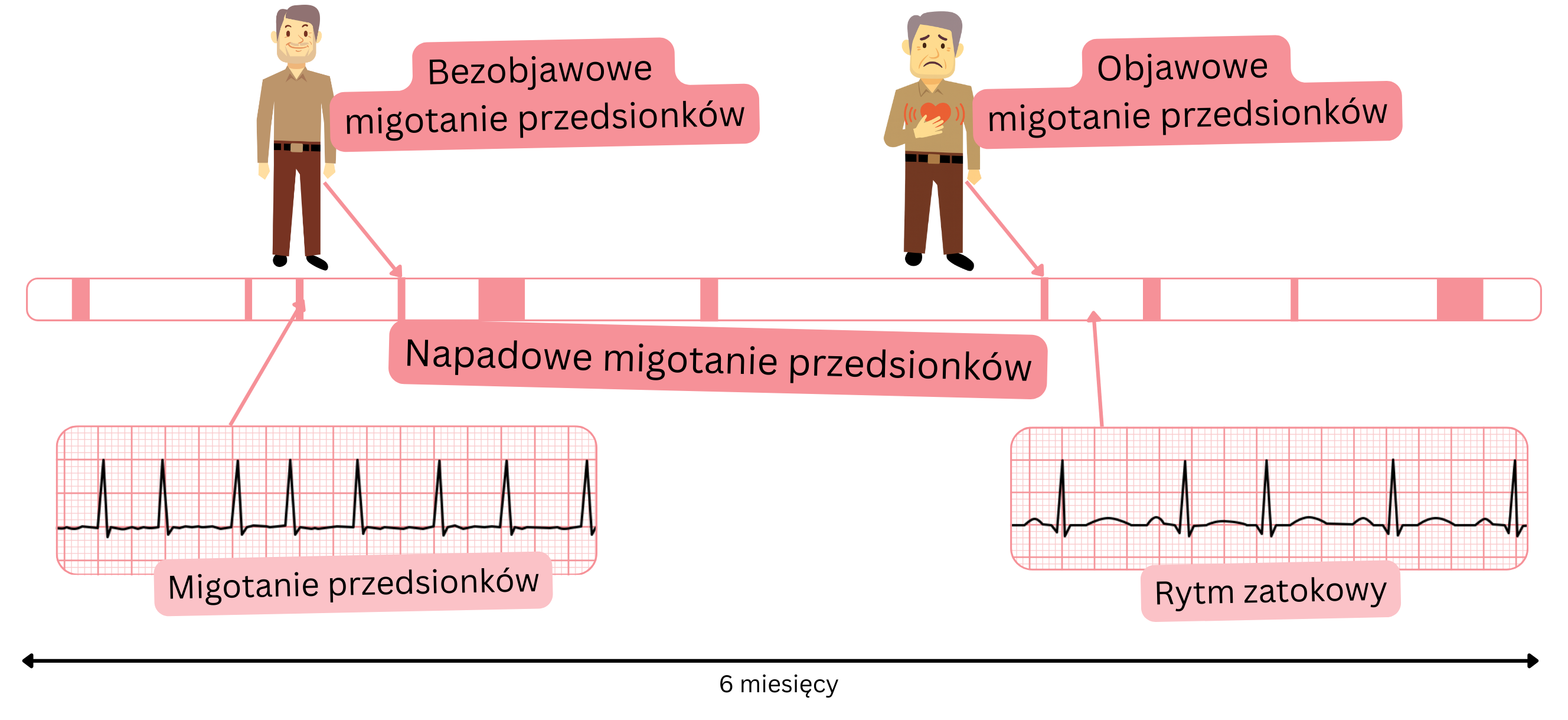 Schemat napadowego migotania przedsionków przedstawiający naprzemienne epizody migotania przedsionków i rytmu zatokowego u pacjentów objawowych i bezobjawowych.