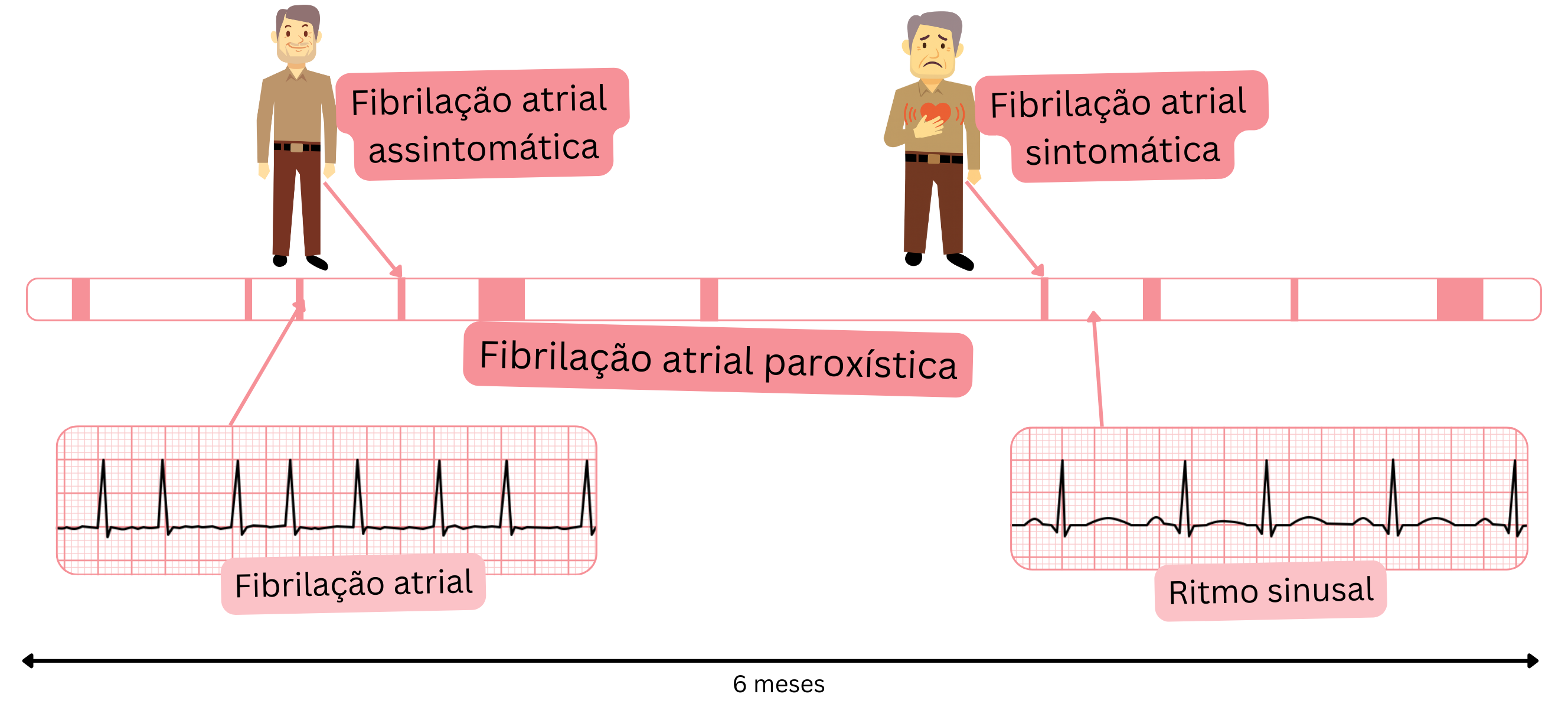 Esquema da fibrilação atrial paroxística ilustrando a alternância de episódios de fibrilação atrial e ritmo sinusal em pacientes sintomáticos e assintomáticos.