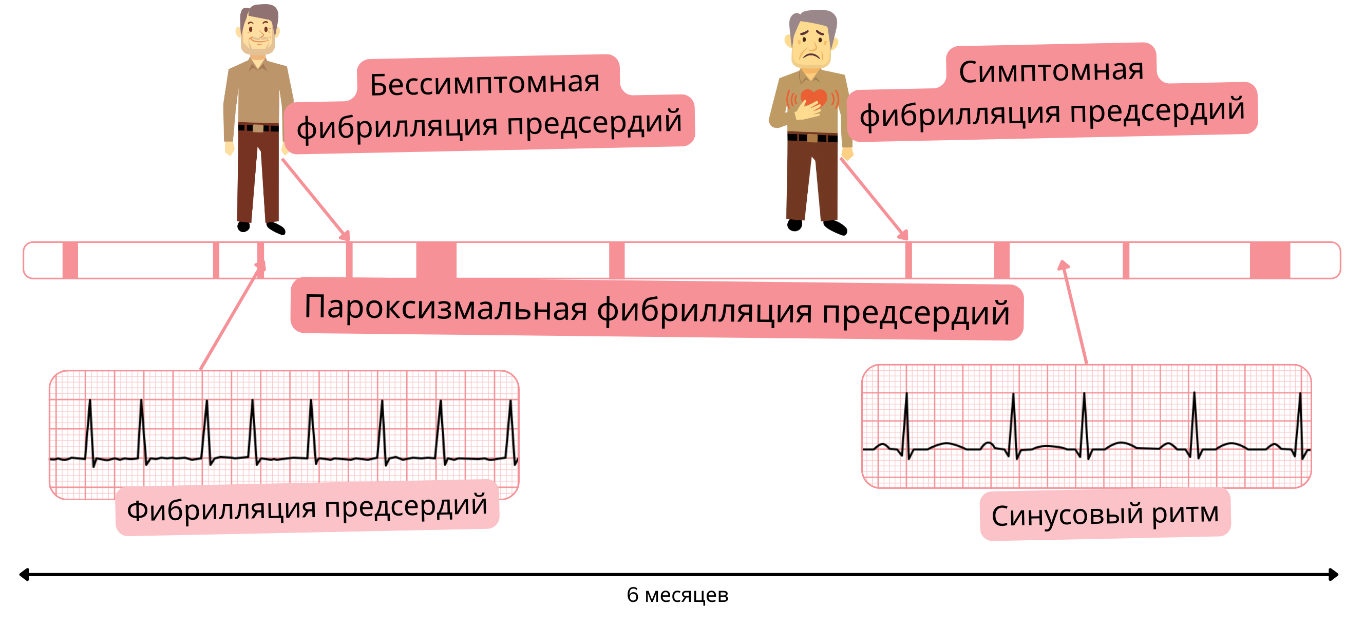 Схема пароксизмальной фибрилляции предсердий, демонстрирующая чередование эпизодов фибрилляции предсердий и синусового ритма у симптомных и бессимптомных пациентов.