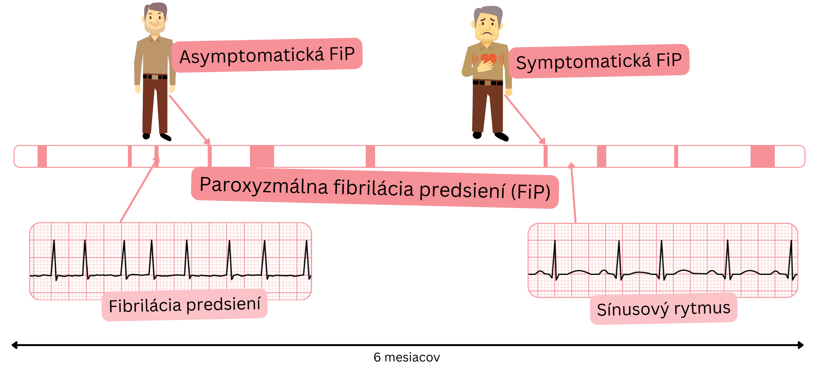 Schéma paroxyzmálnej fibrilácie predsiení znázorňujúca striedanie epizód fibrilácie predsiení a sínusového rytmu u symptomatických a asymptomatických pacientov.