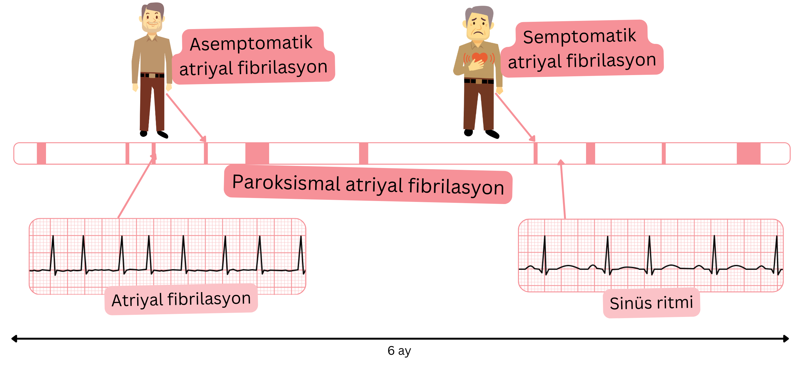 Semptomatik ve asemptomatik hastalarda atriyal fibrilasyon atakları ile sinüs ritminin dönüşümlü olarak görüldüğü paroksismal atriyal fibrilasyonu gösteren şema.