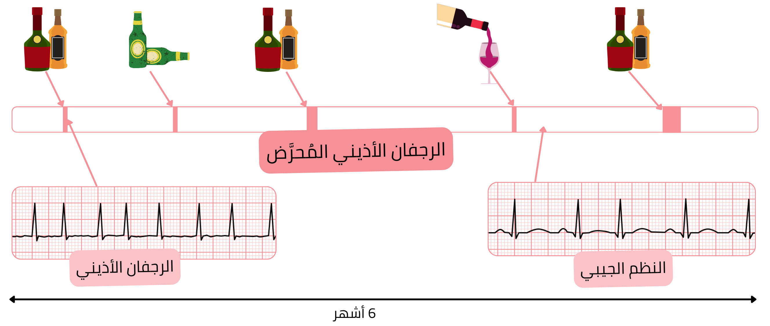 مخطط للرجفان الأذيني المحرَّض مع نوبات ناجمة عن الكحول يعقبها عودة إلى النظم الجيبي.