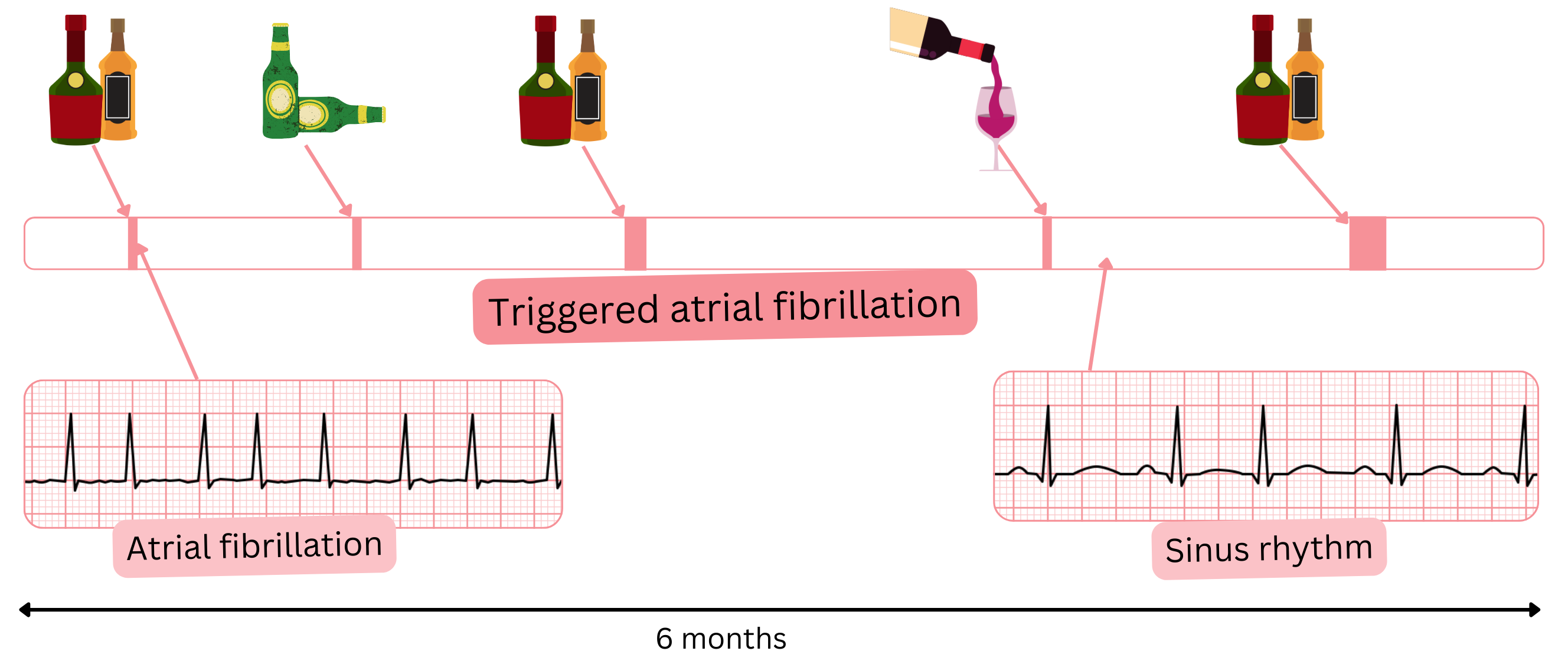 Diagram of trigger-induced atrial fibrillation with alcohol-related episodes followed by spontaneous return to sinus rhythm.