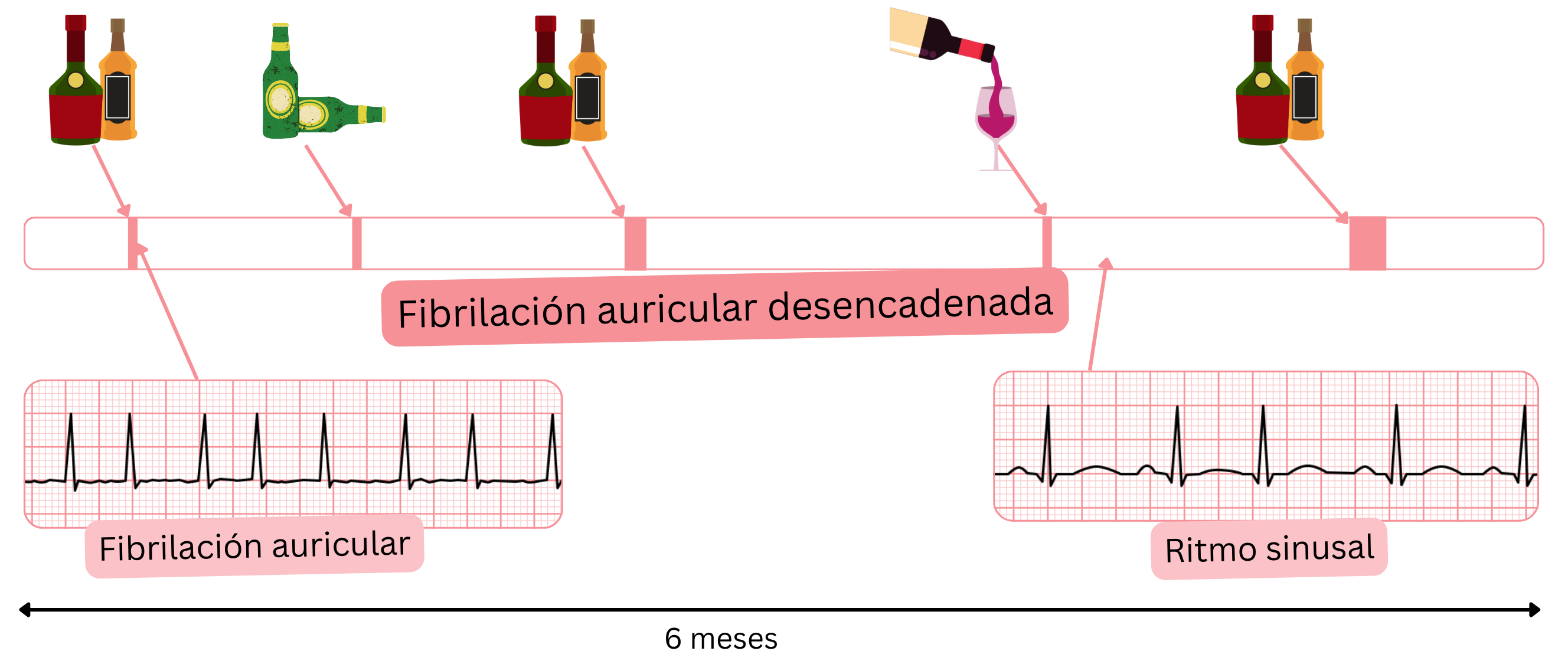 Esquema de la fibrilación auricular desencadenada, con episodios inducidos por alcohol y posterior retorno al ritmo sinusal.