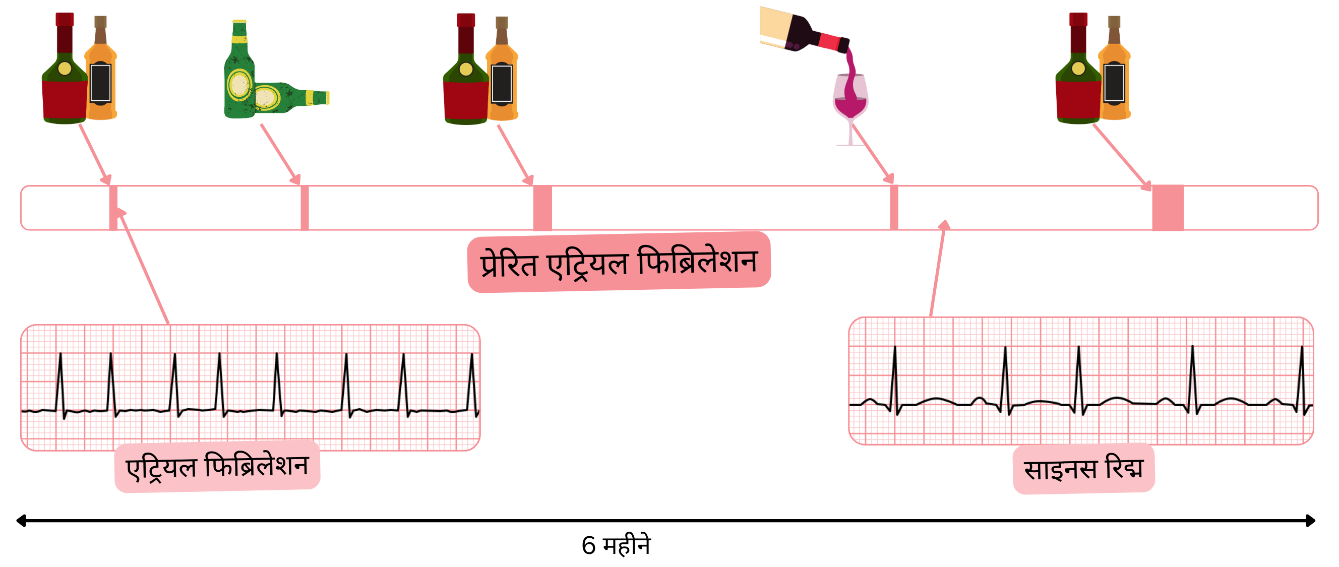 ट्रिगर-प्रेरित एट्रियल फिब्रिलेशन का आरेख, जिसमें शराब से उत्पन्न एपिसोड और उसके बाद साइनस रिद्म में वापसी दिखाई गई है।