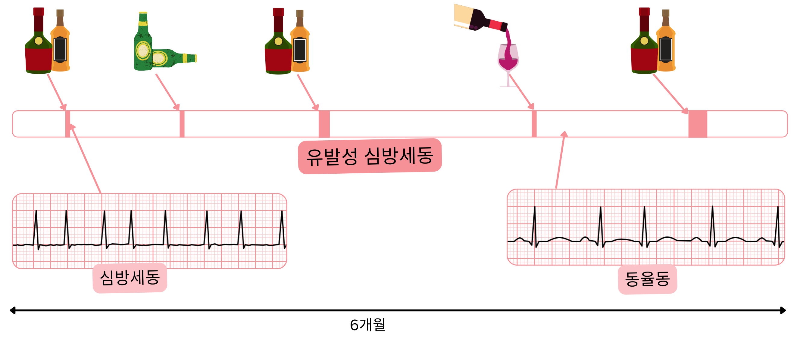 알코올로 유발된 발작 후 동율동으로 회복되는 트리거 유발 심방세동을 보여주는 도식.