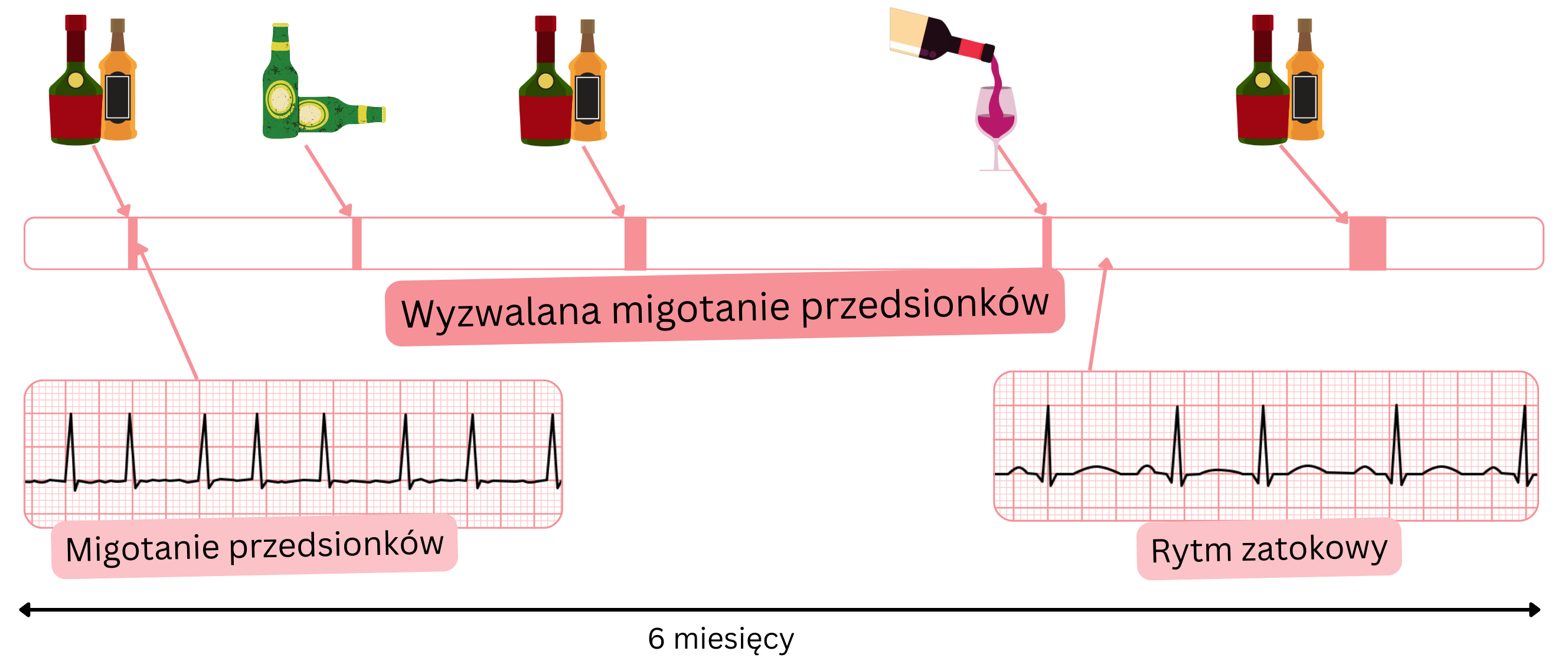 Schemat migotania przedsionków wyzwalanego, z epizodami indukowanymi przez alkohol i następowym powrotem do rytmu zatokowego.