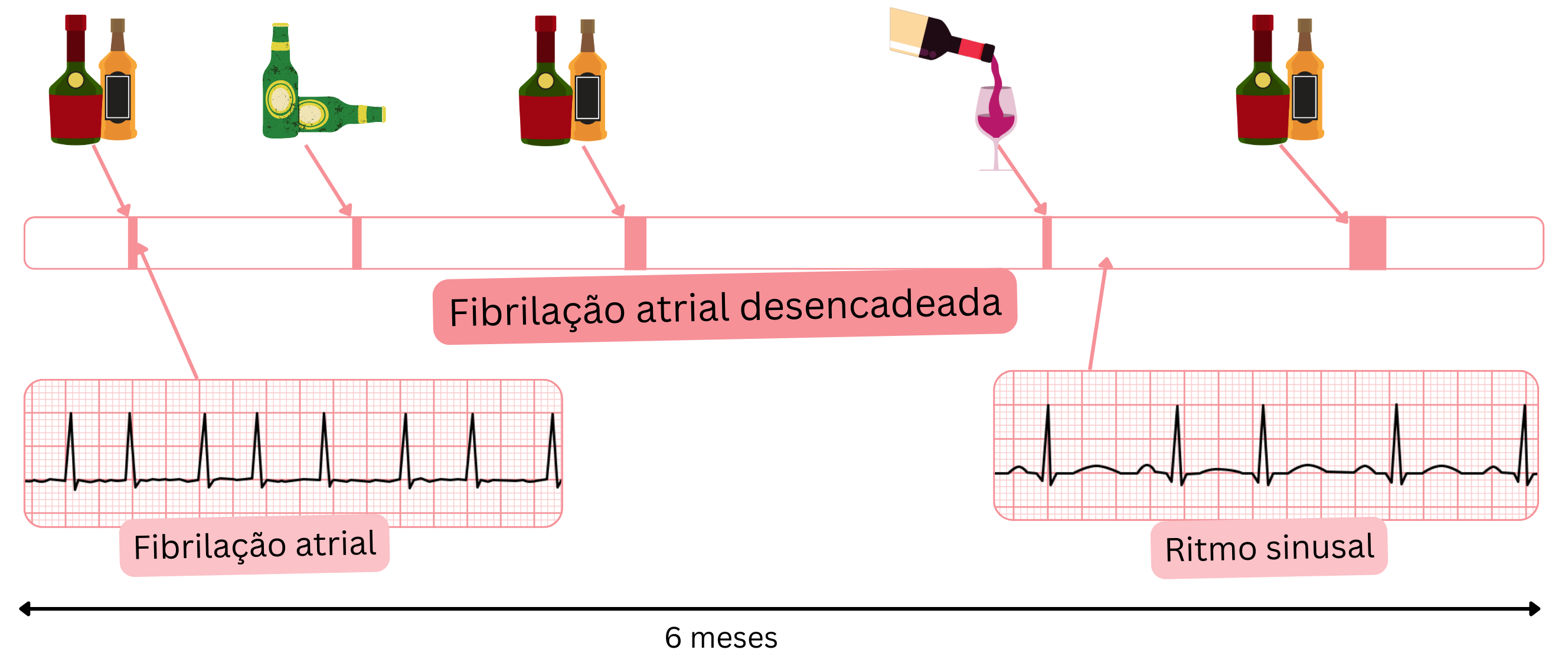 Esquema da fibrilação atrial desencadeada, com episódios induzidos pelo álcool e retorno subsequente ao ritmo sinusal.