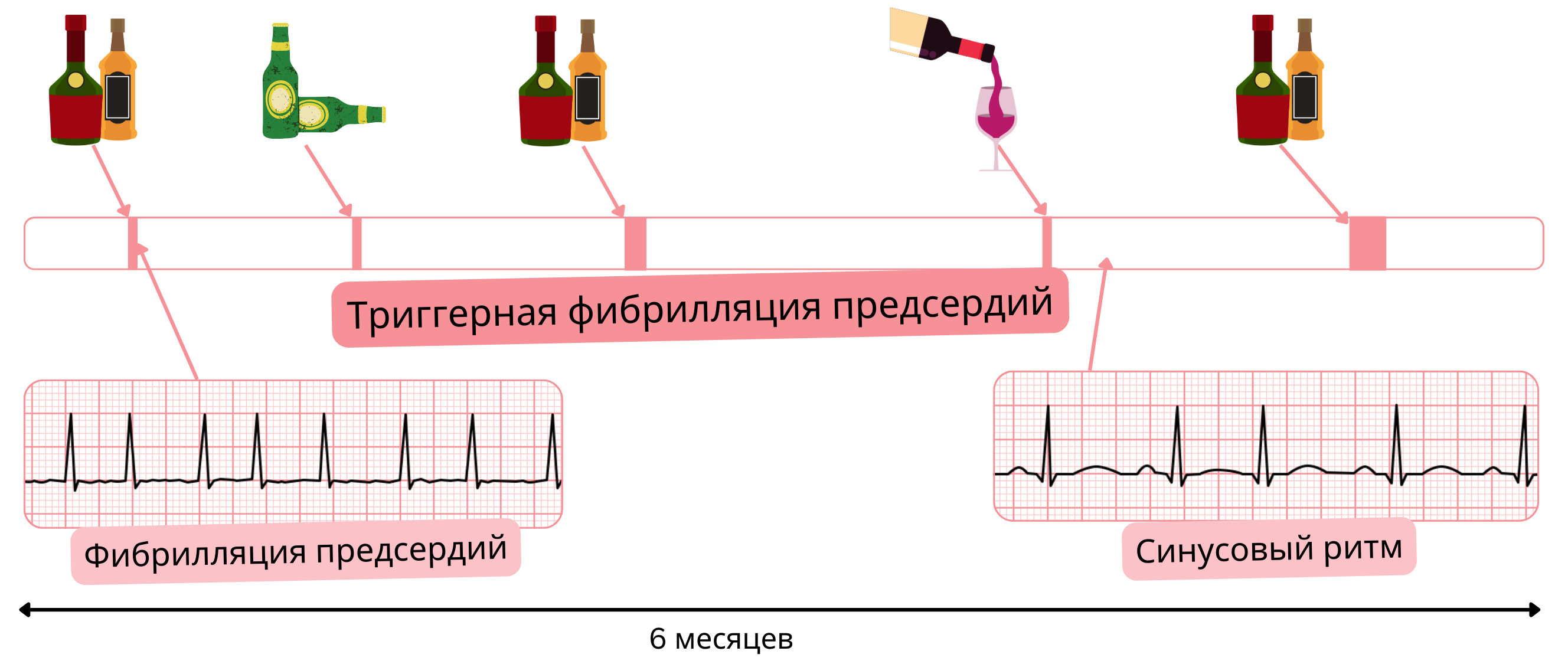 Схема триггерной фибрилляции предсердий с эпизодами, вызванными алкоголем, и последующим возвращением к синусовому ритму.