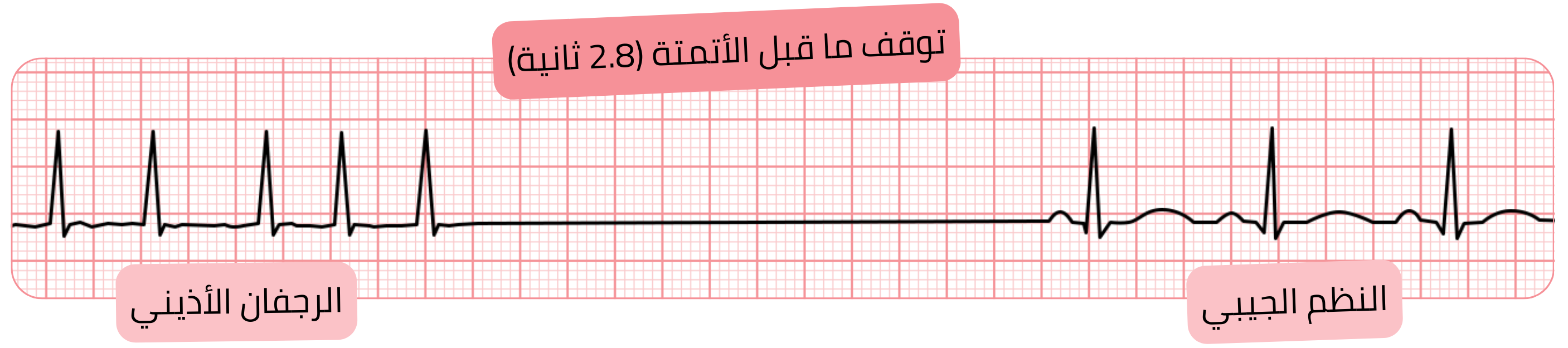 تسجيل تخطيط القلب للرجفان الأذيني مع فترة توقف قبل تلقائية مدتها 2.8 ثانية يعقبها عودة إلى النظم الجيبي.