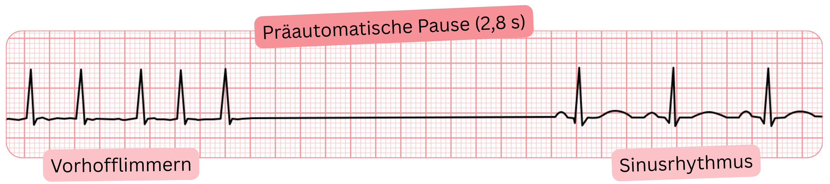 EKG-Aufzeichnung von Vorhofflimmern mit einer präautomatischen Pause von 2,8 s und anschließendem Übergang in den Sinusrhythmus.
