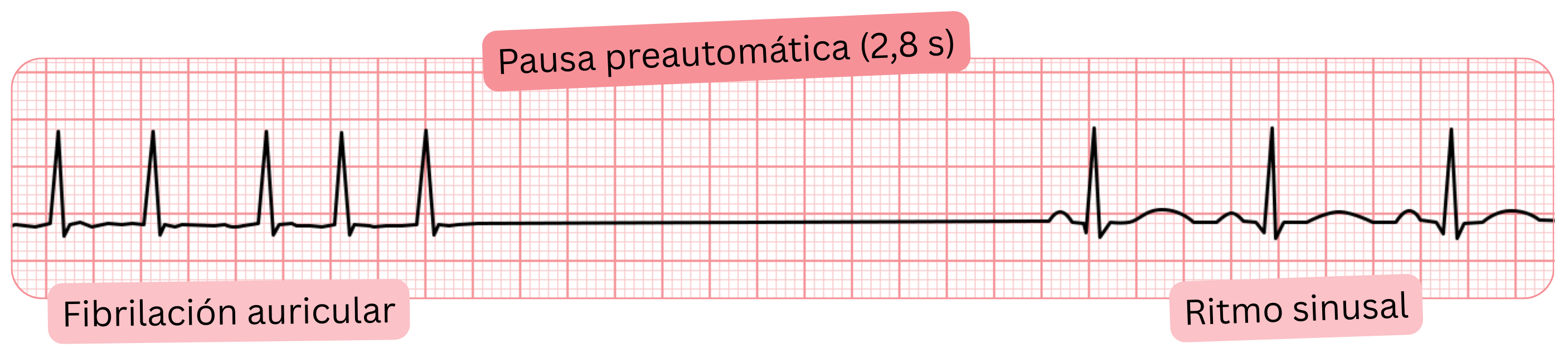 Registro de ECG de fibrilación auricular con una pausa preautomática de 2,8 s y posterior retorno al ritmo sinusal.