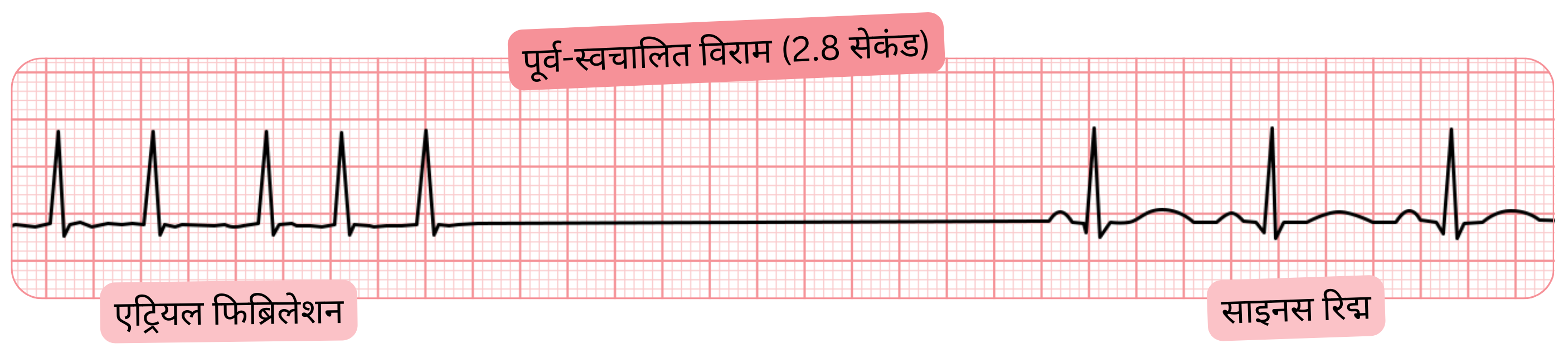 ईसीजी रिकॉर्डिंग जिसमें एट्रियल फिब्रिलेशन के साथ 2.8 सेकंड की प्री-ऑटोमैटिक पॉज़ और उसके बाद साइनस रिद्म में वापसी दिखाई गई है।