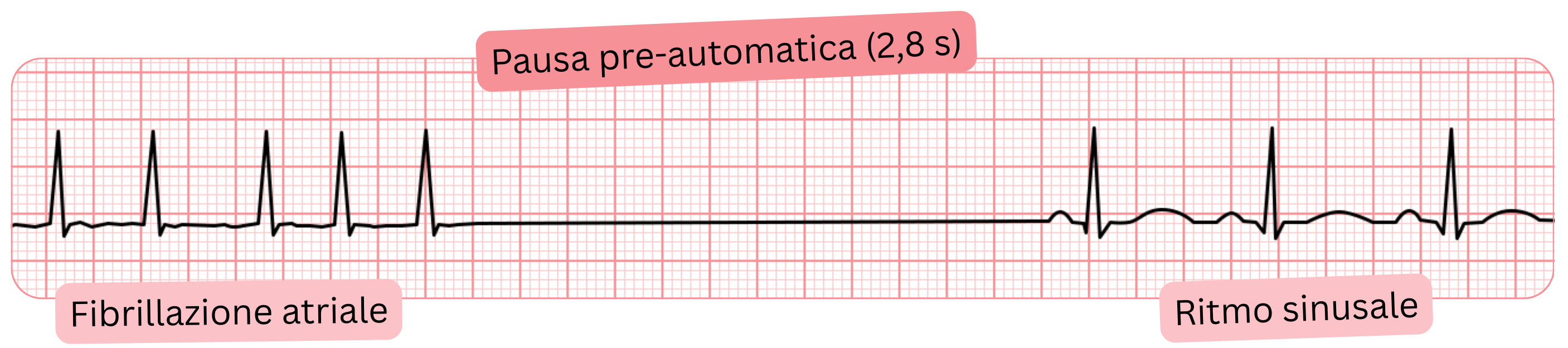 Registrazione ECG di fibrillazione atriale con pausa preautomatica di 2,8 s e successivo ritorno al ritmo sinusale.