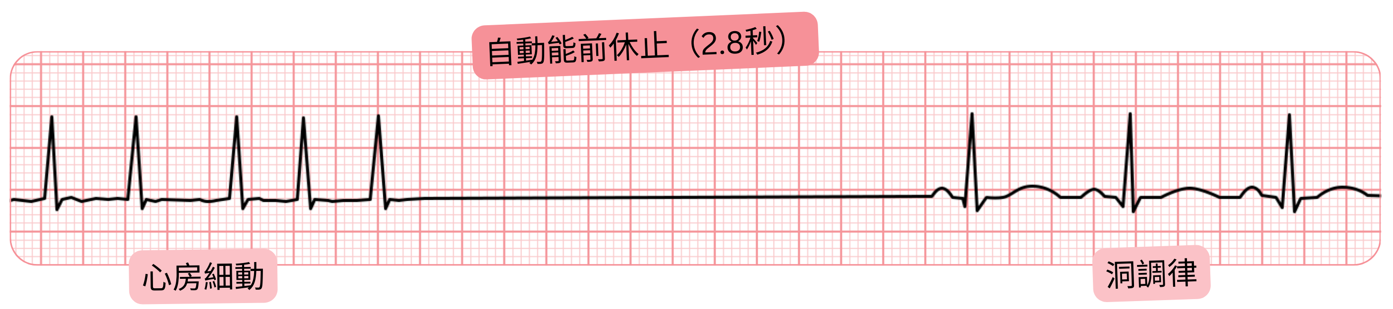 2.8秒の前自動能性ポーズを伴う心房細動の心電図記録で、その後洞調律へ復帰している。