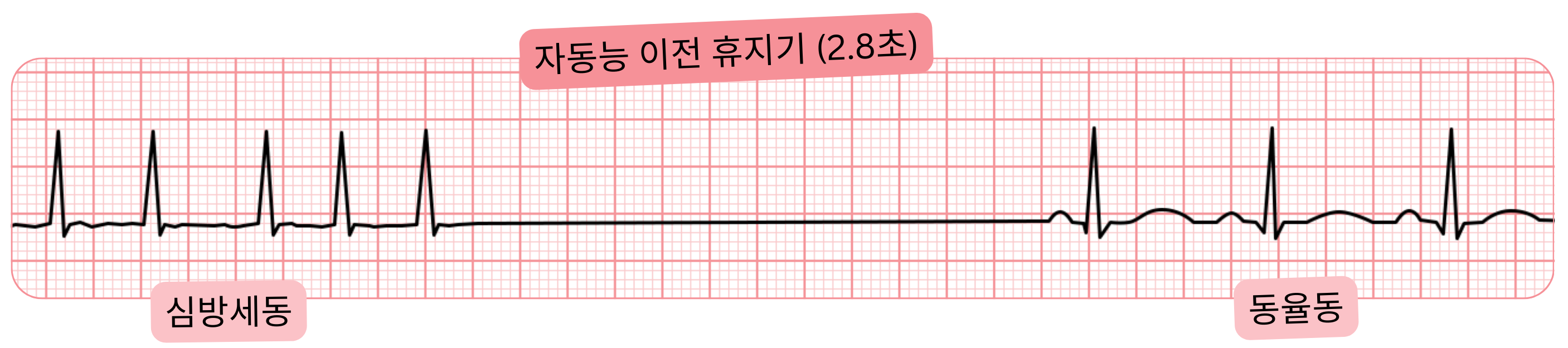 2.8초의 전자동성 휴지기를 동반한 심방세동의 심전도 기록으로, 이후 동율동으로 회복됨을 보여준다.