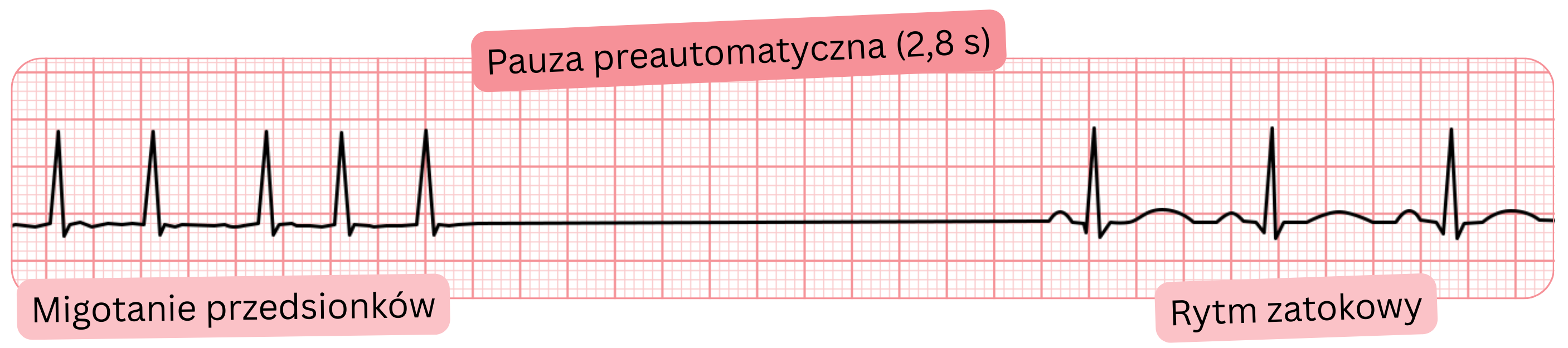 Zapis EKG migotania przedsionków z pauzą preautomatyczną 2,8 s i następowym powrotem do rytmu zatokowego.