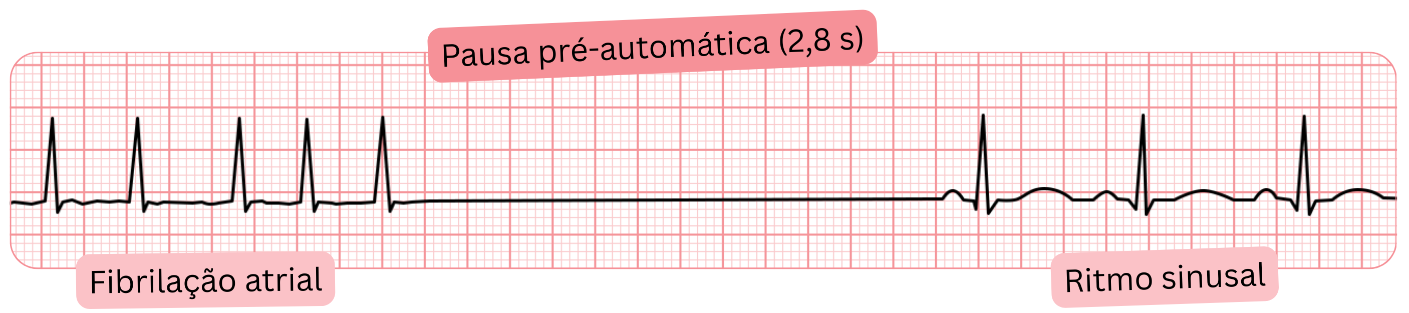 Registo de ECG de fibrilação atrial com pausa pré-automática de 2,8 s e subsequente retorno ao ritmo sinusal.