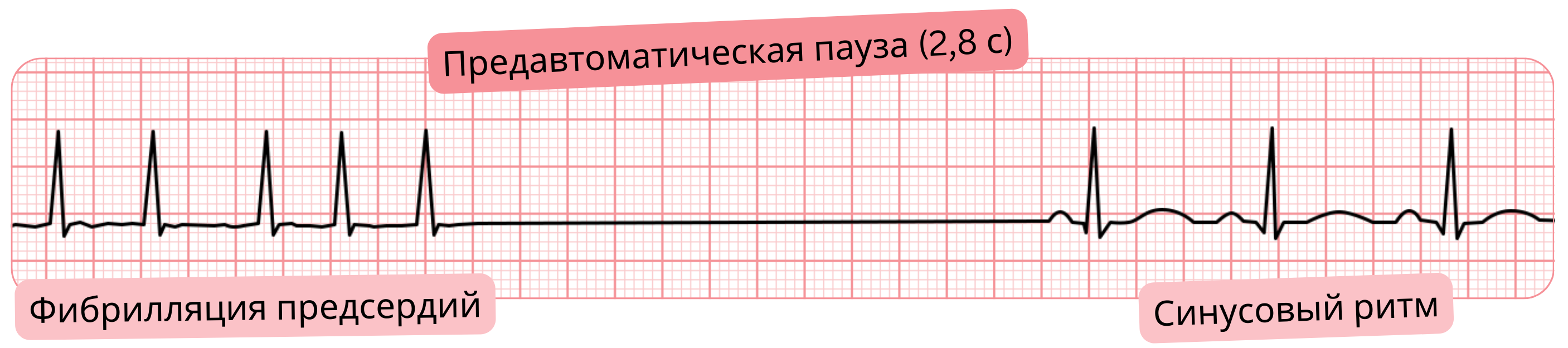 ЭКГ-запись фибрилляции предсердий с преавтоматической паузой 2,8 с и последующим восстановлением синусового ритма.