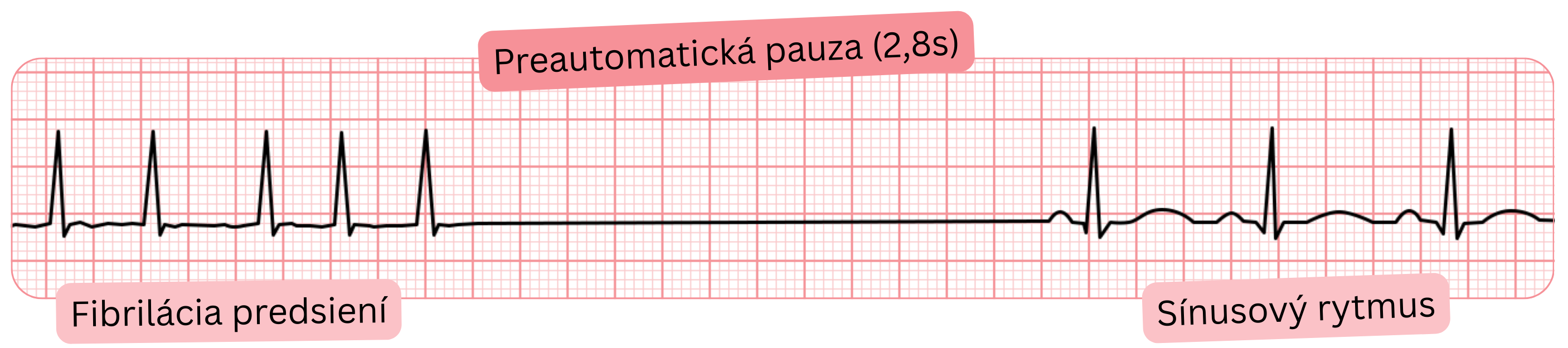EKG záznam fibrilácie predsiení s preautomatickou pauzou 2,8 s a následným návratom do sínusového rytmu.