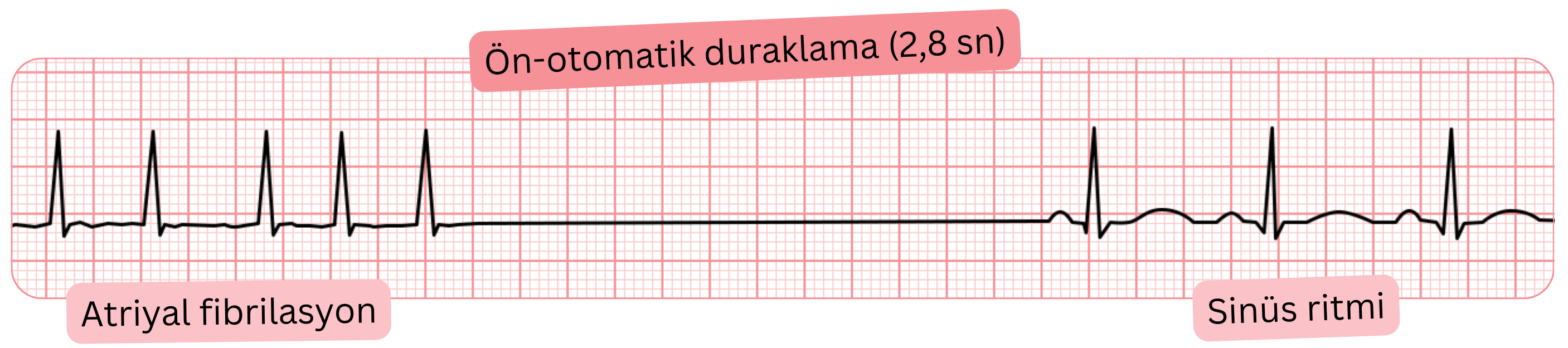 2,8 sn’lik preotomatik duraklama ve ardından sinüs ritmine dönüş ile seyreden atriyal fibrilasyonun EKG kaydı.