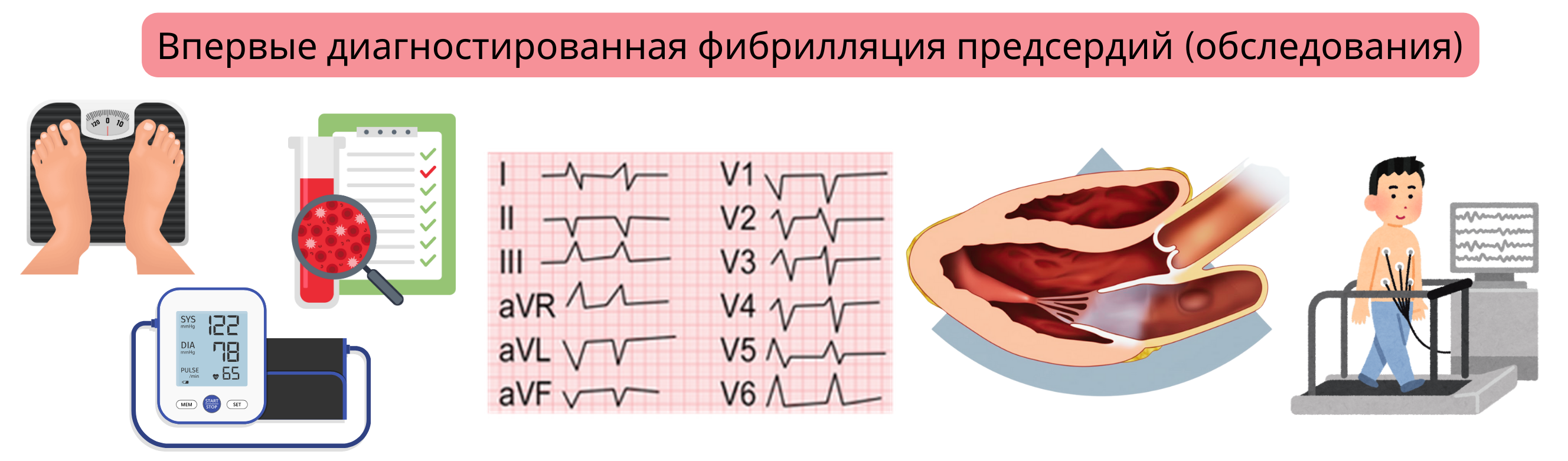 Инфографика, демонстрирующая базовое обследование при впервые диагностированной фибрилляции предсердий, включая ЭКГ, лабораторные анализы, эхокардиографию и нагрузочный тест.