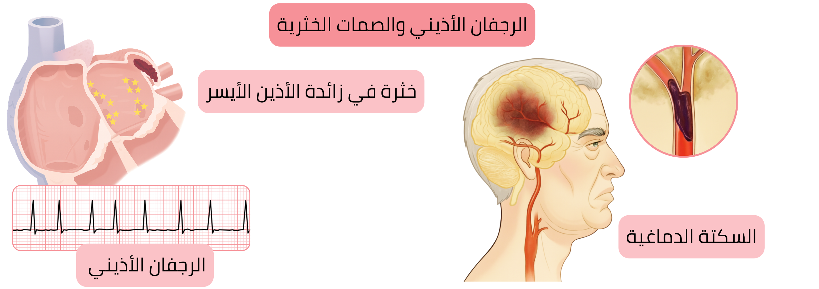 رسم توضيحي لآلية الخثار الصمي في الرجفان الأذيني مع تشكّل خثرة في زائدة الأذين الأيسر وحدوث سكتة دماغية إقفارية لاحقًا.