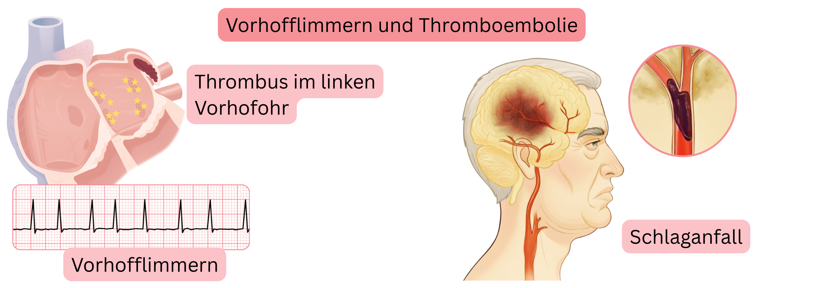 Illustration der Thromboembolie bei Vorhofflimmern mit Thrombusbildung im linken Vorhofohr und nachfolgendem ischämischem Schlaganfall.