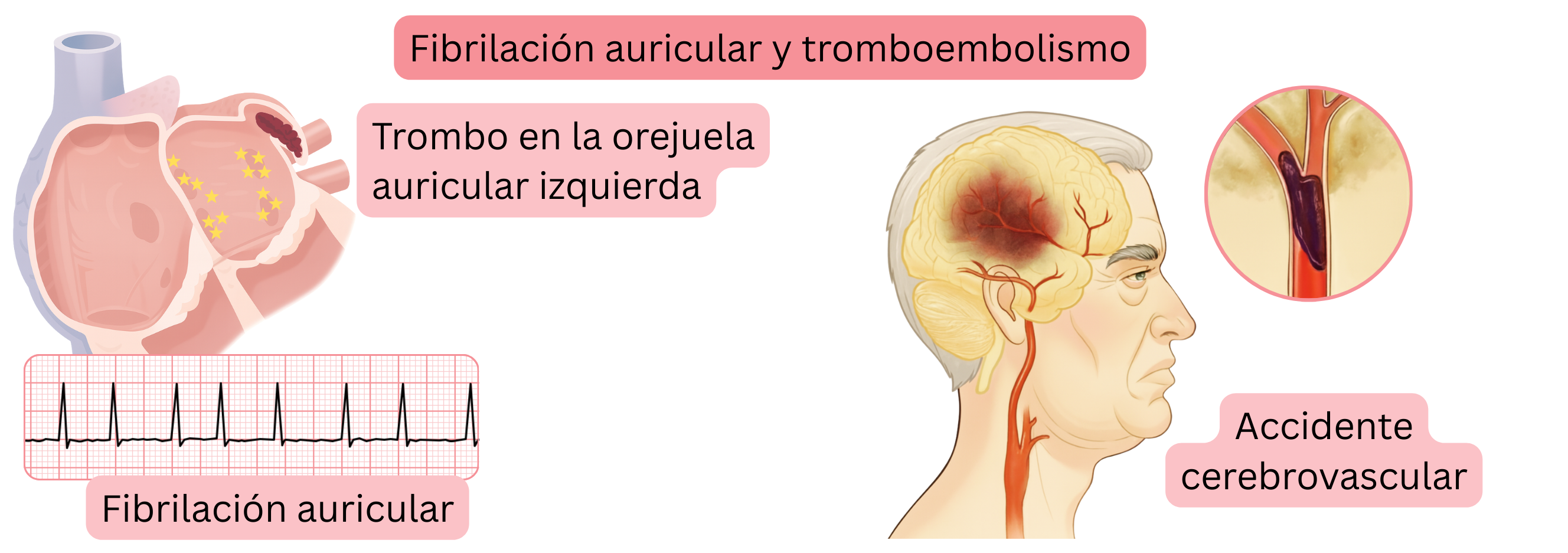 Ilustración del tromboembolismo en la fibrilación auricular con formación de trombo en la orejuela izquierda y posterior accidente cerebrovascular isquémico.