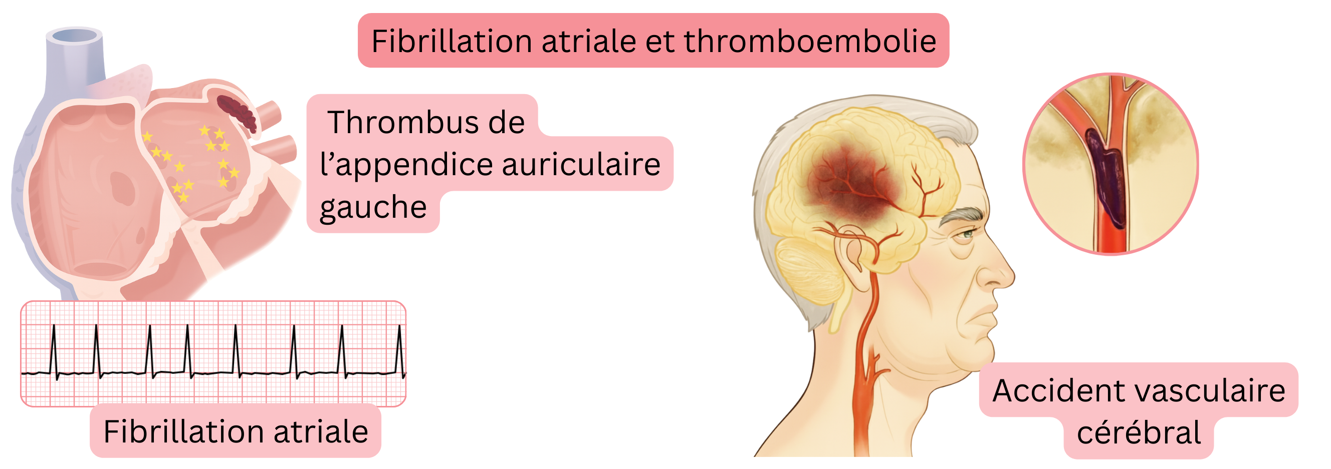 Illustration du thromboembolisme dans la fibrillation atriale avec formation d’un thrombus dans l’appendice auriculaire gauche et survenue d’un accident vasculaire cérébral ischémique.
